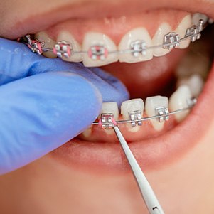 A closeup of a dentist adjusting a patient’s braces