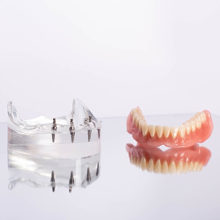 An All-on-4 denture