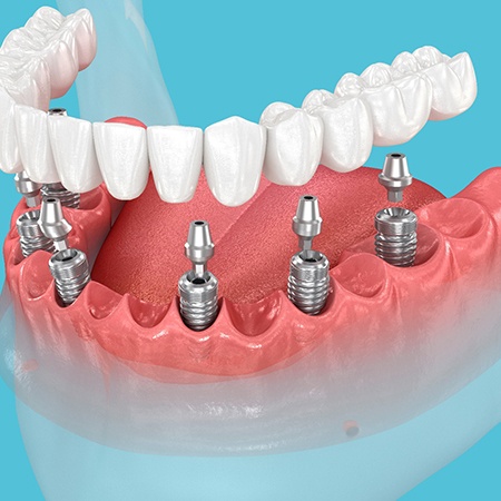 A traditional implant denture