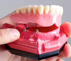 Model of All-on-4 denture