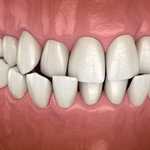 Illustration of crossbite