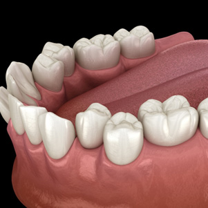 Illustration of crooked teeth