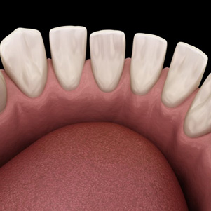 Illustration of teeth with gaps