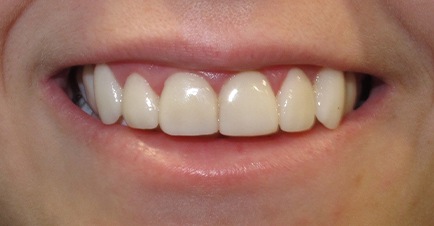 Teeth after dental treatment