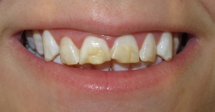 Teeth before dental treatment