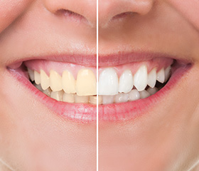 Closeup smile half before and half after teeth whitening