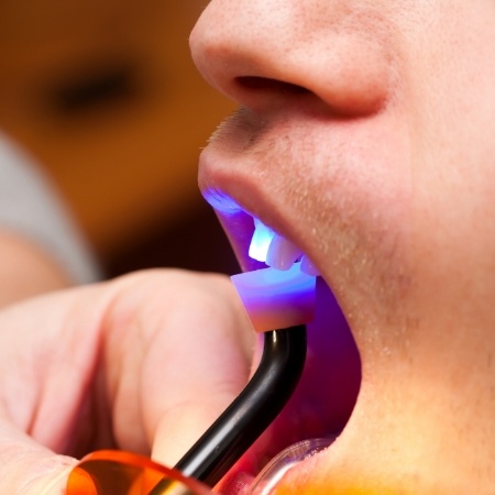 Patient receiving a direct bonding treatment