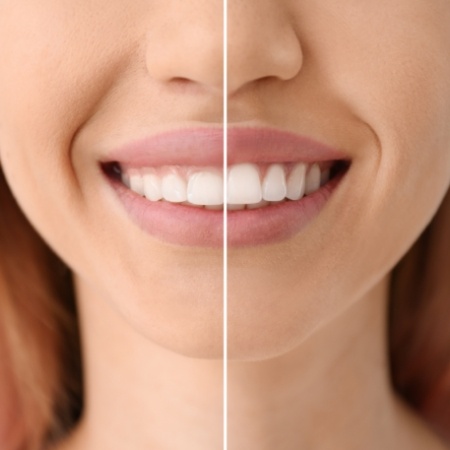 Before and after gum recontouring