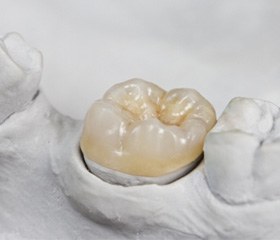 Dental crown in Port Orange, FL on impression of lower arch