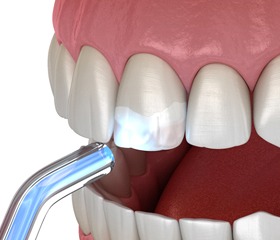 Dental bonding in Port Orange