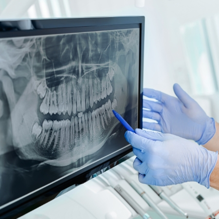 Illustration of dental implant and a crown