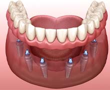 3D illustration of an implant denture