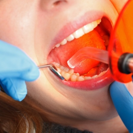 Close up of mouth during direct bonding