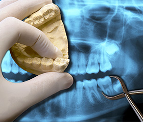 Model and x-rays of teeth to be extracted