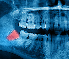 X-ray of impacted wisdom teeth