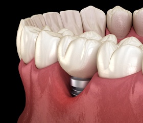 Illustration of peri-implantitis, a common cause of dental implant failure