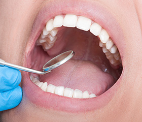 Closeup of smile during dental treatment