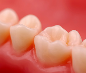 Closeup of teeth after filling placement