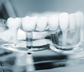 model of dental implant