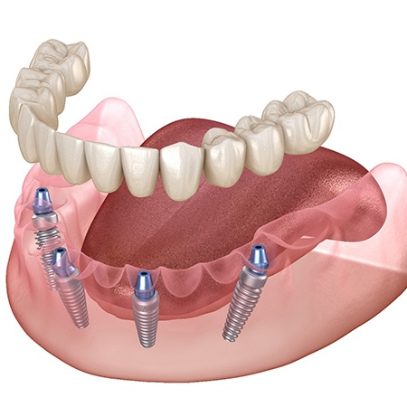 Illustration of implant dentures in Port Orange