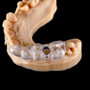 Guide for dental implant surgery on model of teeth