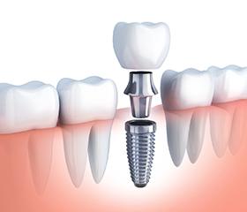 dental implant in Port Orange with abutment and crown