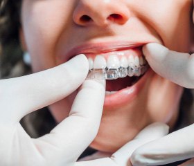 Dentist placing clear aligner on patient's top teeth
