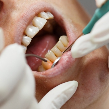 Teeth being treated with soft tissue laser