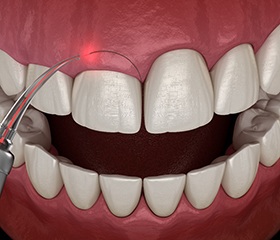 Gum recontouring being performed with laser dentistry in Port Orange, FL