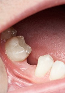 patient with gap in smile 
