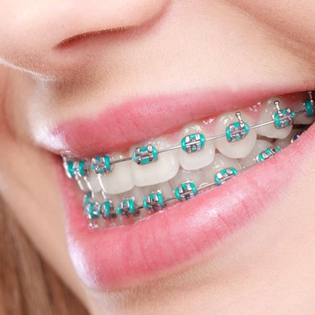 Close-up of person’s smile with traditional braces