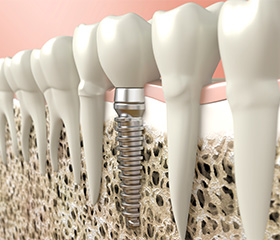 Animation of implant supported dental crown