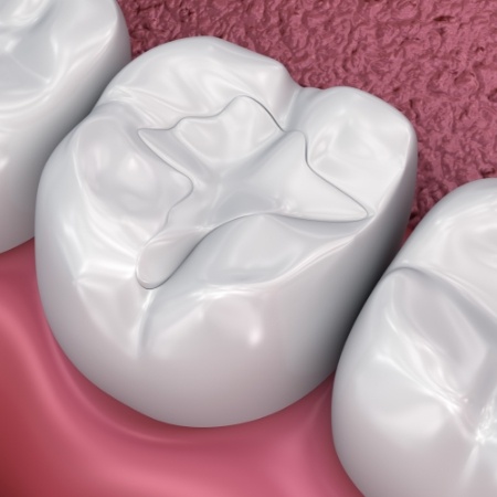 Tooth colored filling for tooth in lower arch