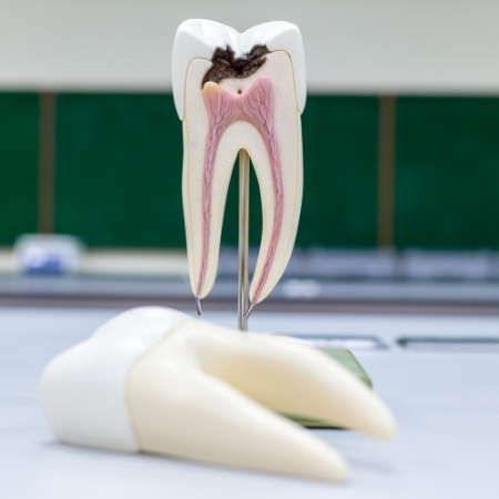 Model of an infected tooth that needs root canal treatment in Port Orange