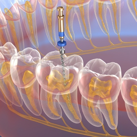 Woman receiving dental treatment