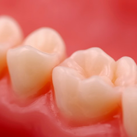 Close up of teeth in lower arch