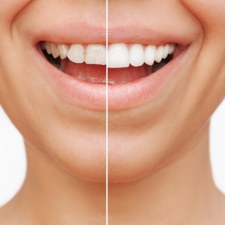 Before and after veneers