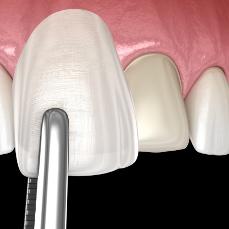 Veneer being placed on a tooth