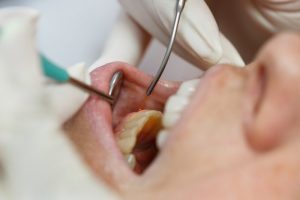 a dentist performing laser gum recontouring on a patient