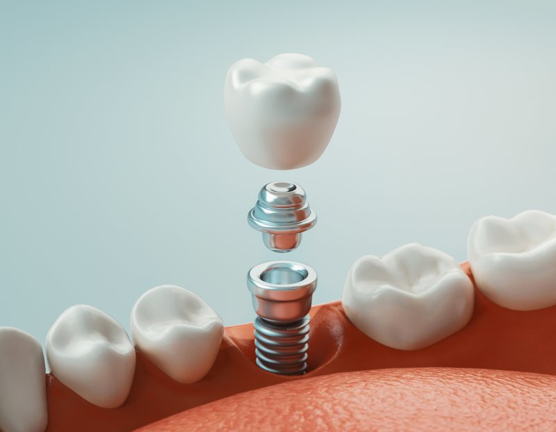A 3D rendering of a titanium dental implant and its parts