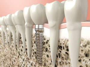 Model of single dental implant